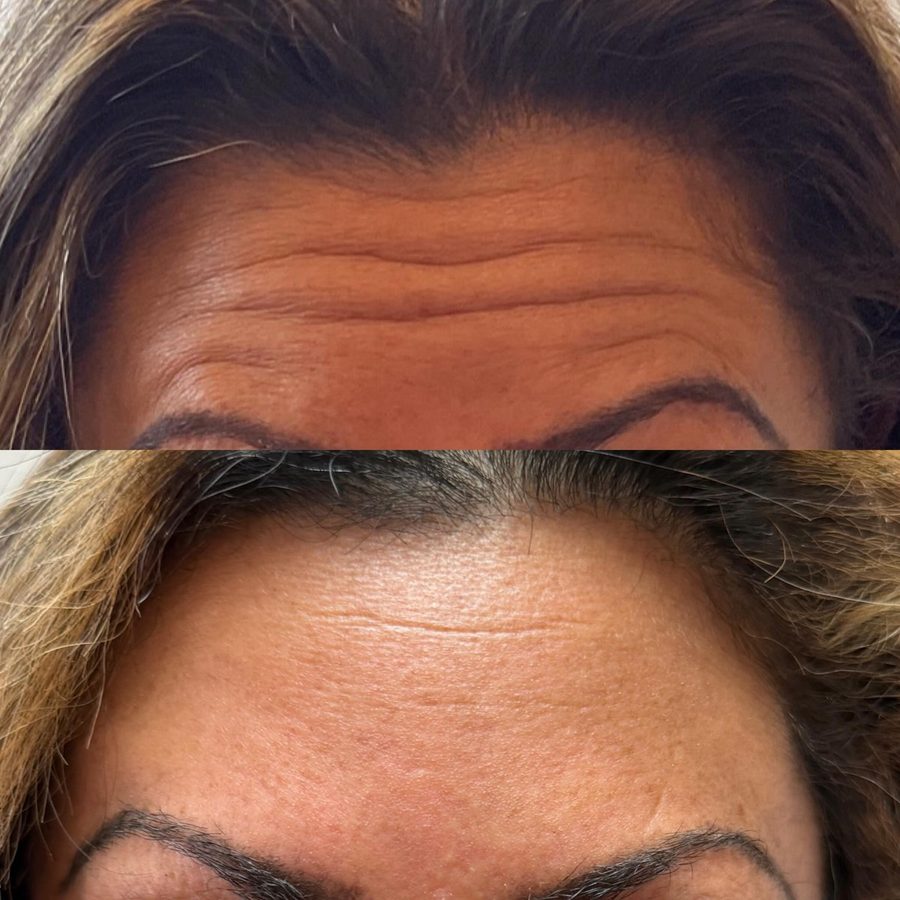 Botox before and after — forehead lines visibly softened, by Nada Hannawi, DNP in Ridgewood, NJ