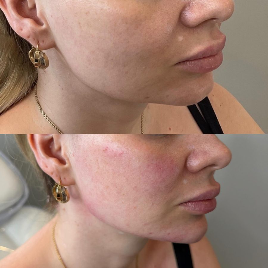 Facial balancing before and after — subtle profile refinement by Nada Hannawi, DNP