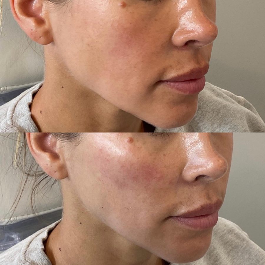 Biostimulator before and after — lifted, contoured jawline and cheek