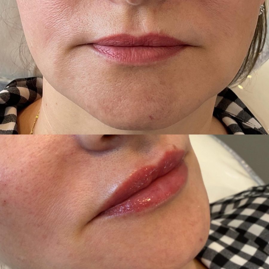 Subtle lip filler before and after — soft volume and definition