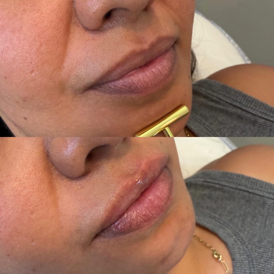 Lip filler before and after — a natural plump with defined shape