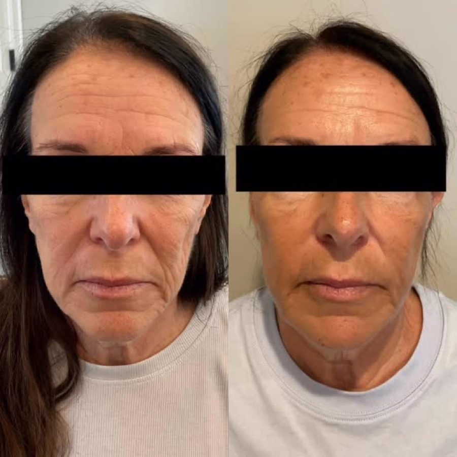 Facial rejuvenation progress over two months at Aesthetics by NHT