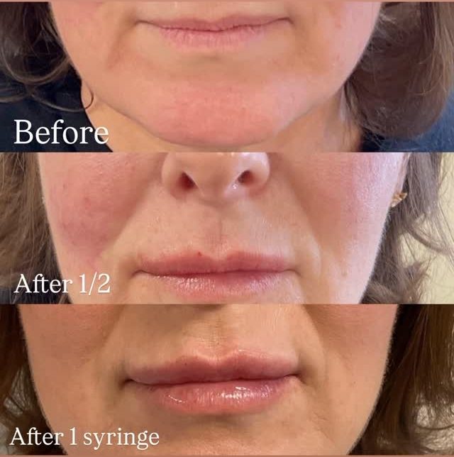 Lip filler progression before, after half a syringe and after one syringe