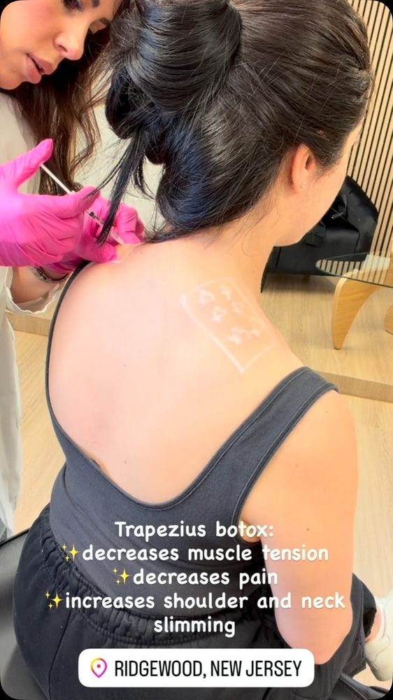 Trapezius Botox treatment for shoulder and neck tension at Aesthetics by NHT
